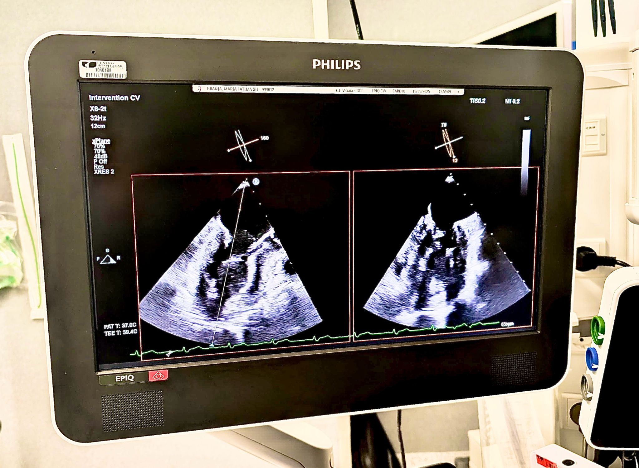 Pioneiros na implantação de neocordas em Portugal